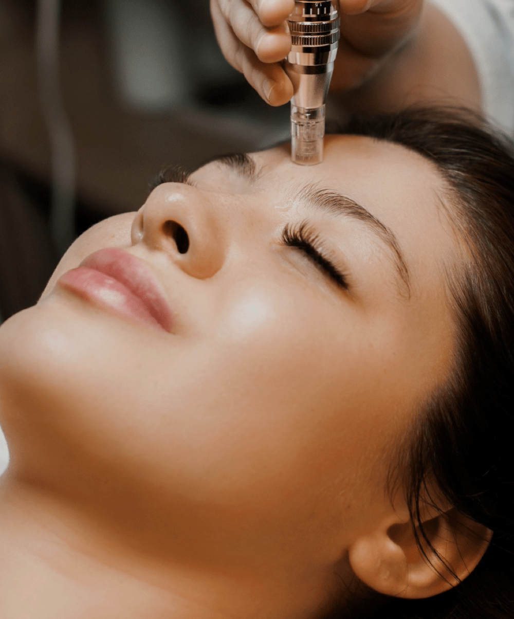 Microneedling